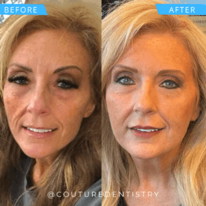 Before and After Treatment image Botox in Plano Texas