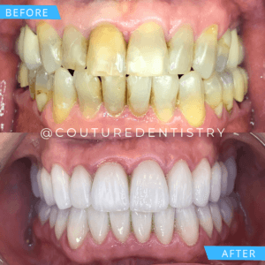 Before and After Treatment image Cosmetic Dentistry in Plano Texas