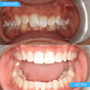 Before and After Treatment image Teeth | Couture Dentistry in Plano, TX