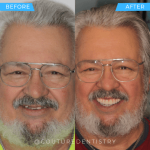 Before and After Treatment image 4 | Cosmetic Dentistry in Plano Texas