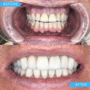 Before and After Treatment Cosmetic Dentistry | Couture Dentistry in Plano, TX