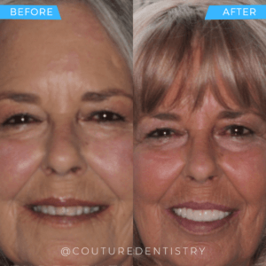 Before and After Treatment image botox