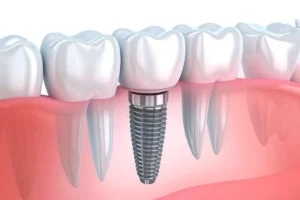 Dental Implants by Couture Dentistry In Plano, Texas