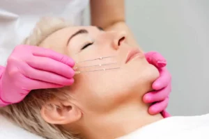PDO Threads Lift by Nelson Lo, DDS PC in Plano, TX