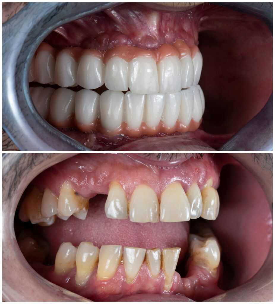 Oral Hygiene Tips to Maintain Healthy Dental Implants 3 Advanced Dental Implants at Couture Dentistry in Plano, TX
