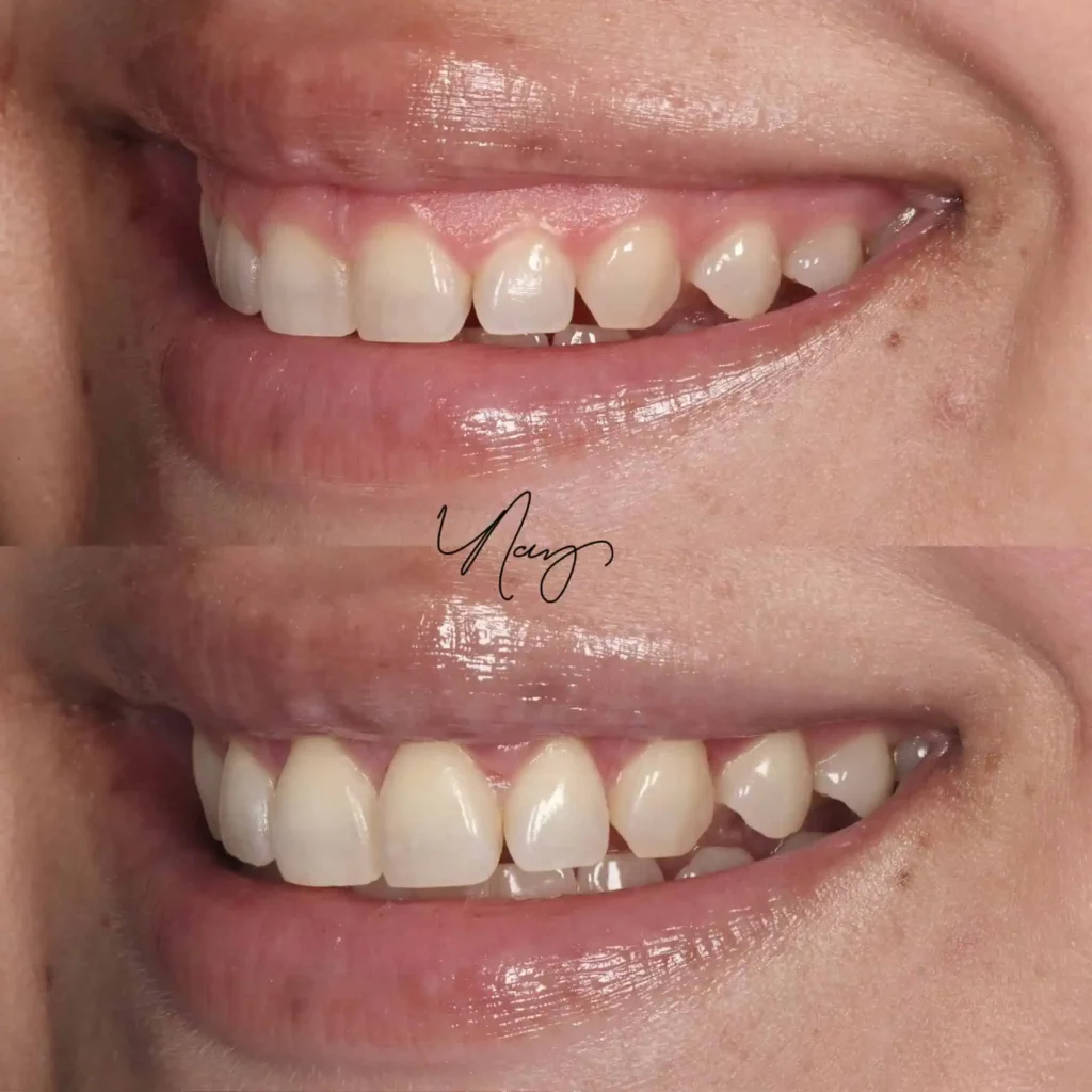 Gum Lift Before After IMG a2