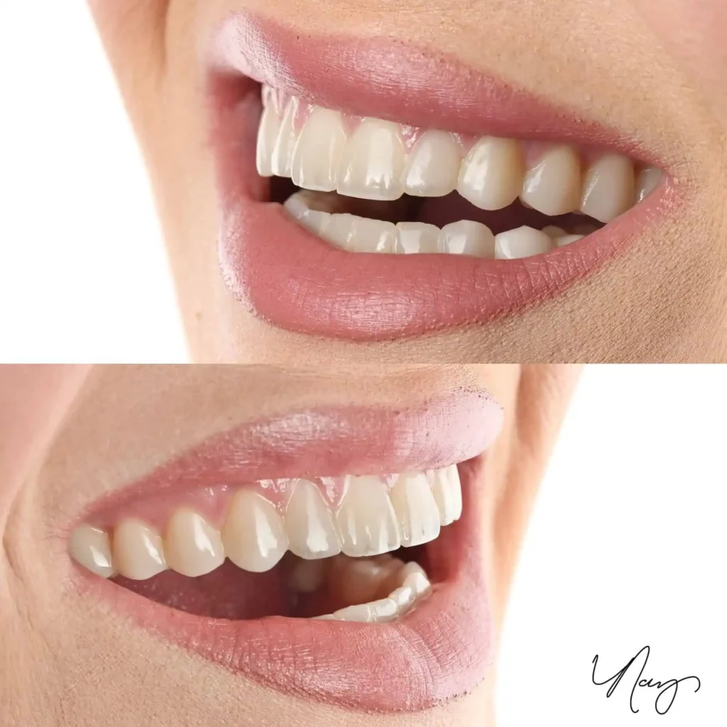 Smile Makeover Before after IMG 8D65