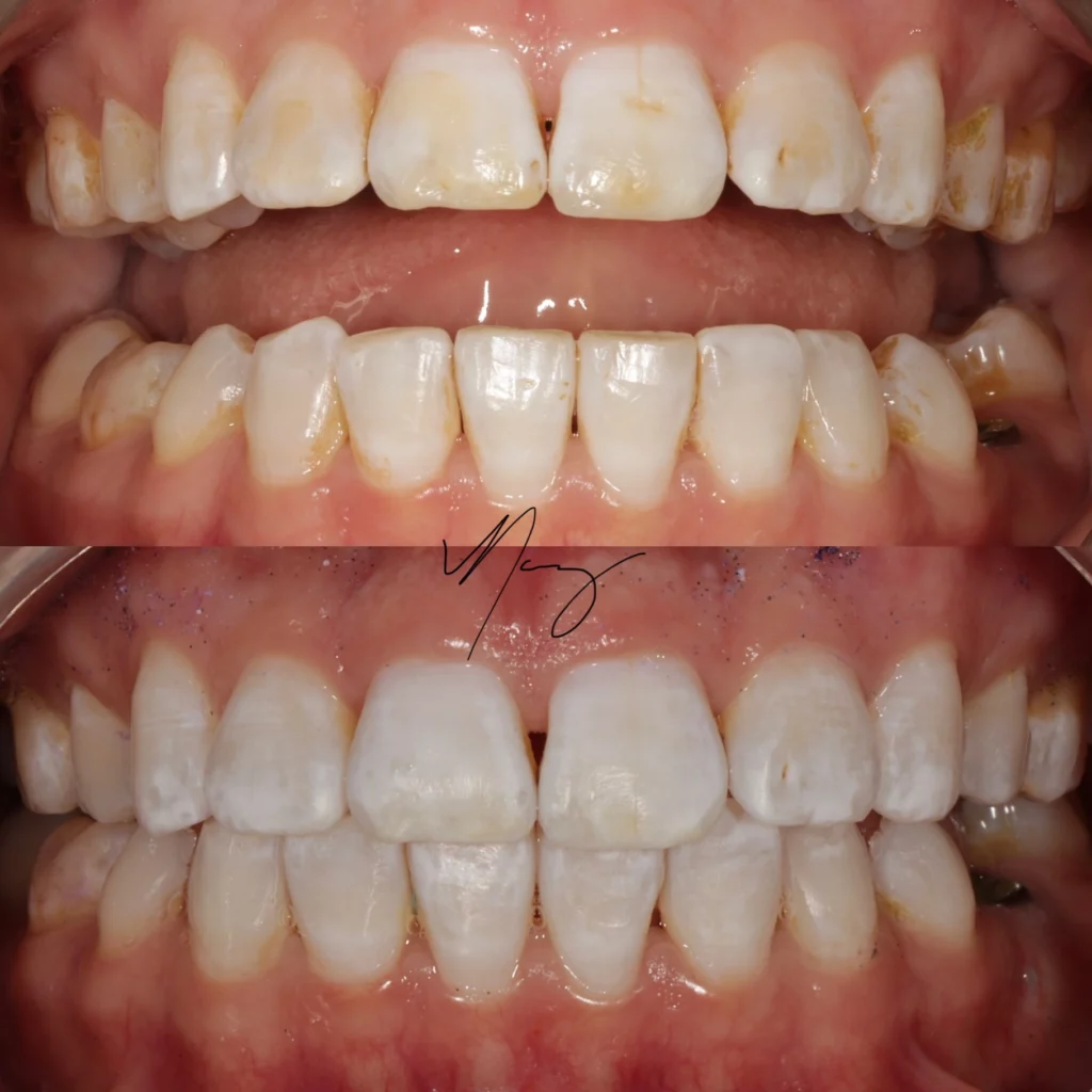 Portfolio 2 Whitening White Spot Removal Before and After