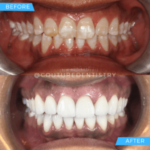 Before and After Treatment image Cosmetic Dentistry